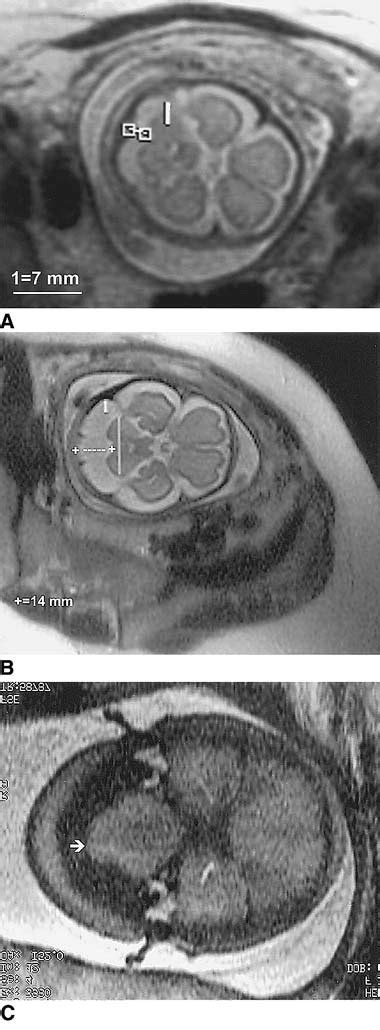 is mega cisterna magna dangerous|Abnormalities of the Fetal Central Nervous System: .
